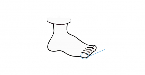 Tegning av en fot med fokus på lilletåa.